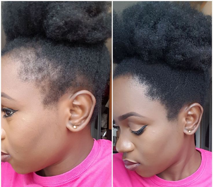 Customer result — Before shows thinning edges on the side of the head. After shows fuller, restored hairline growth after BANGLOG HAIR MAGIC routine