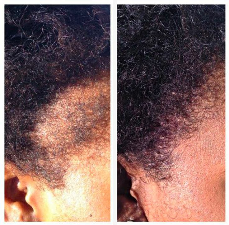 Customer hair result — Before shows thinning area near the temple. After shows regrowth and improved hair density in the same area