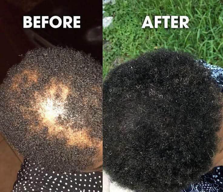 Customer hair result — Before shows patchy, sparse hair on crown. After shows noticeably fuller, healthy-looking natural hair after using BANGLOG HAIR MAGIC products