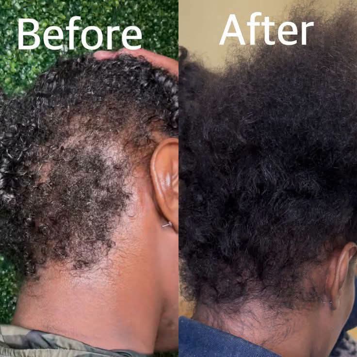 Customer hair result — Before shows thinning hair around the sides and temples. After shows fuller, healthier-looking hair growth in the same areas
