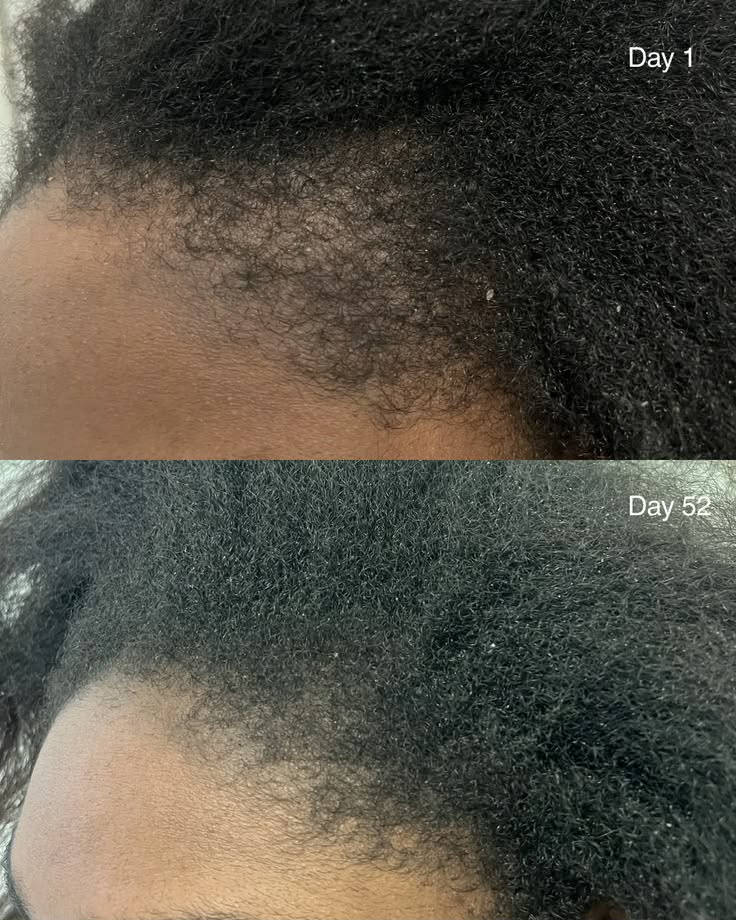 Customer hair result — Day 1 shows sparse, thin edges. Day 52 shows noticeably fuller, denser hair along the hairline after consistent use of BANGLOG HAIR MAGIC