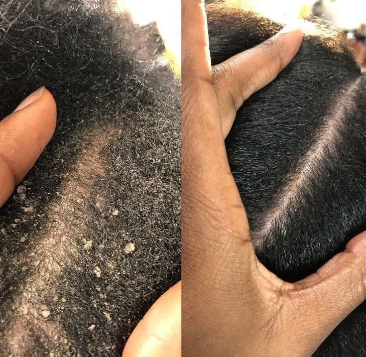 Customer scalp result — Before shows significant dandruff and scalp buildup. After shows a clean, clear, noticeably healthier scalp
